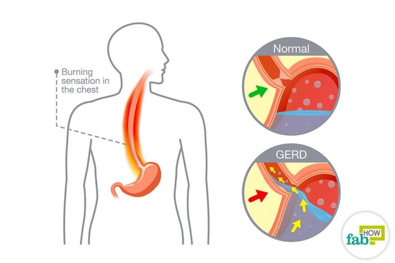 Feel the burn? Here’s what you can do about it. - North Country Hospital